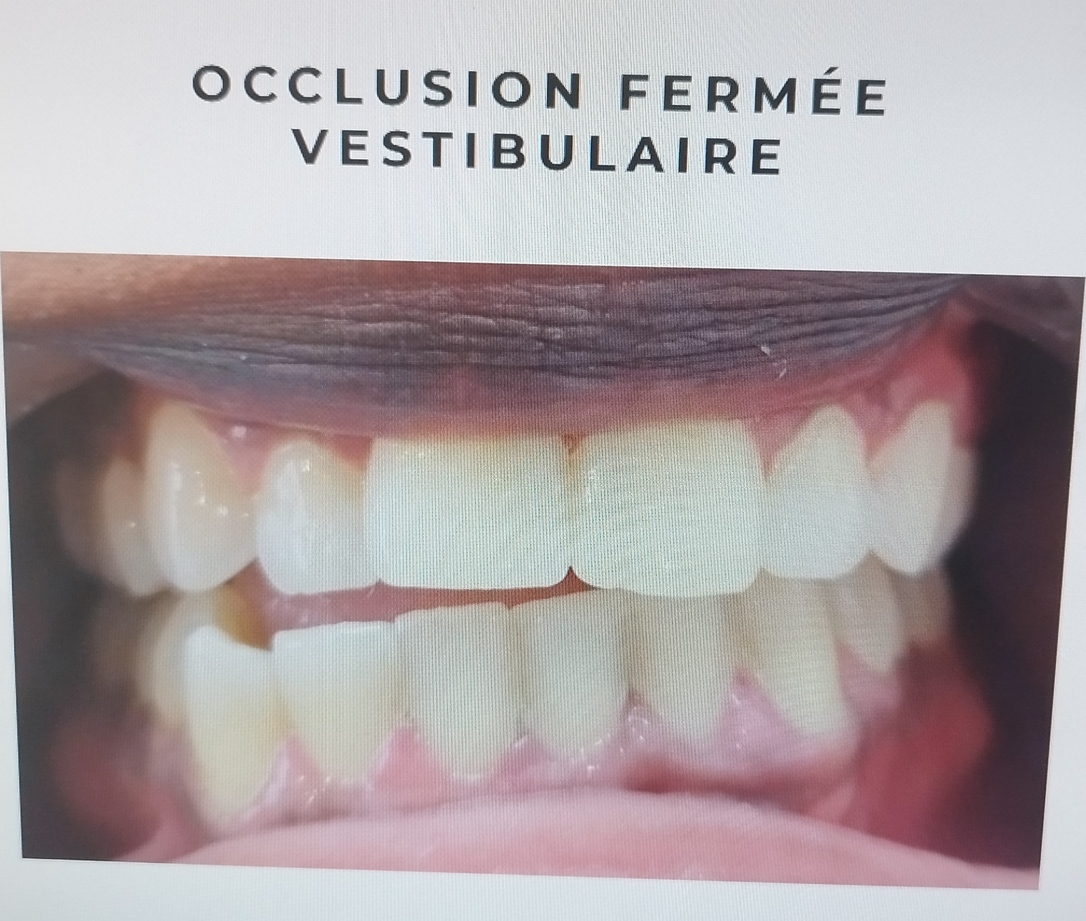 blanchiment dentaire à Tournan en Brie