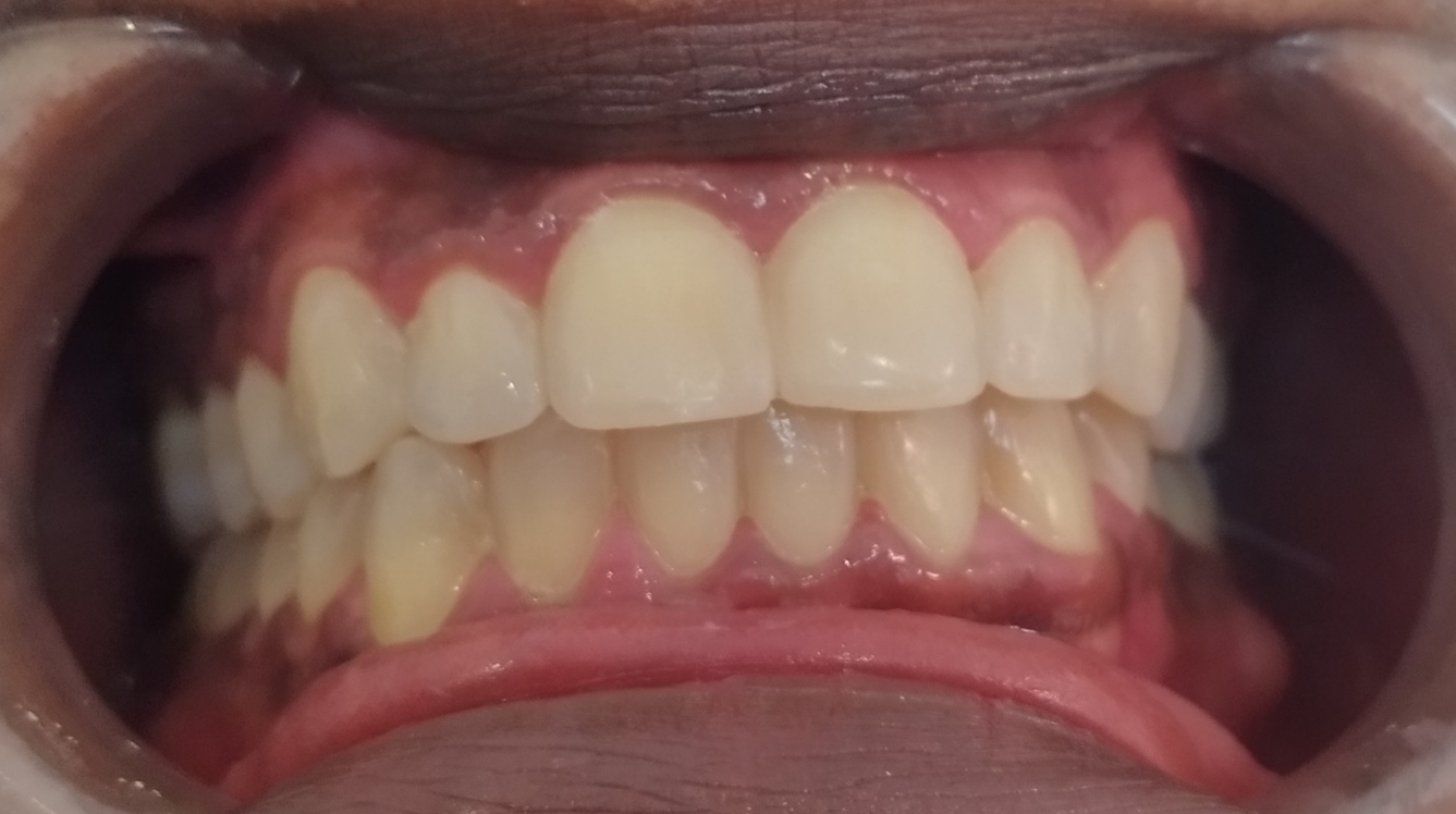 blanchiment dentaire apres Tournan en Brie