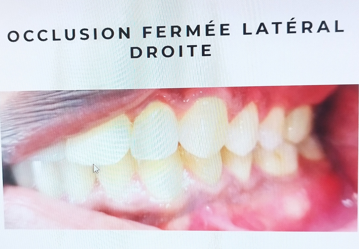 blanchiment dentaire à Tournan en Brie