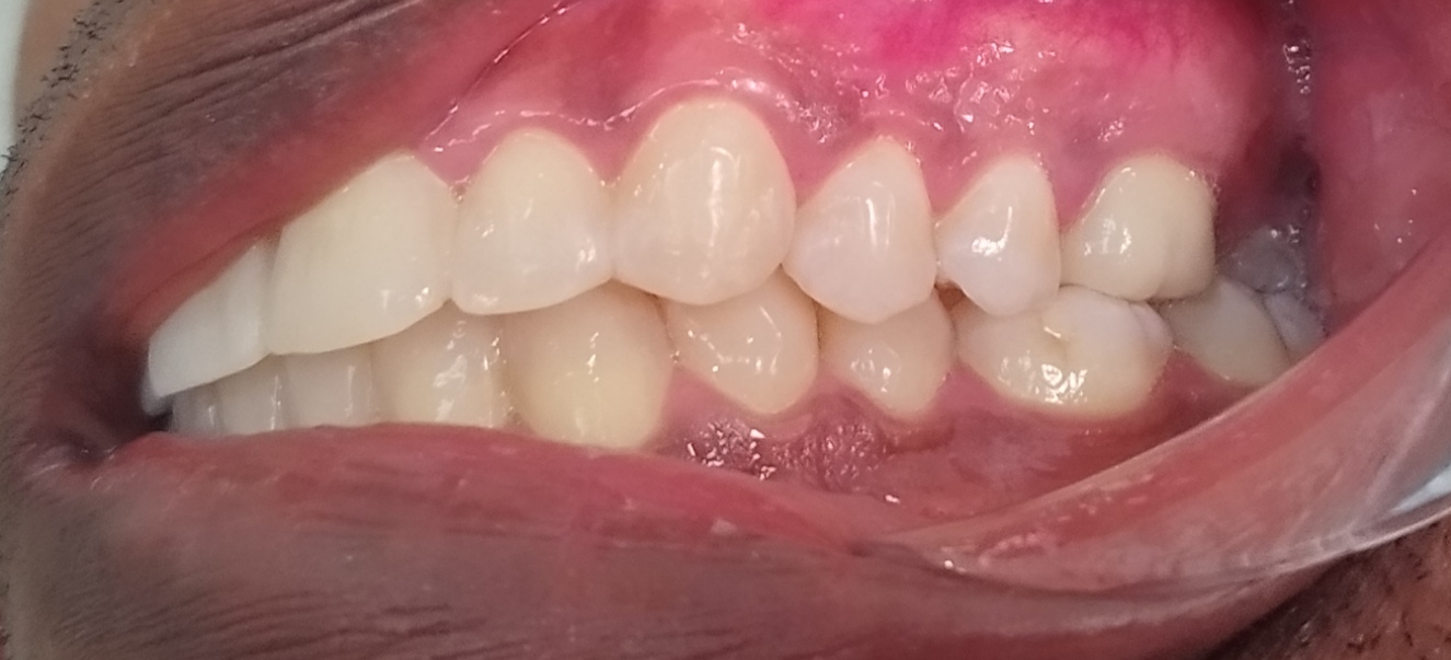 blanchiment dentaire apres Tournan en Brie