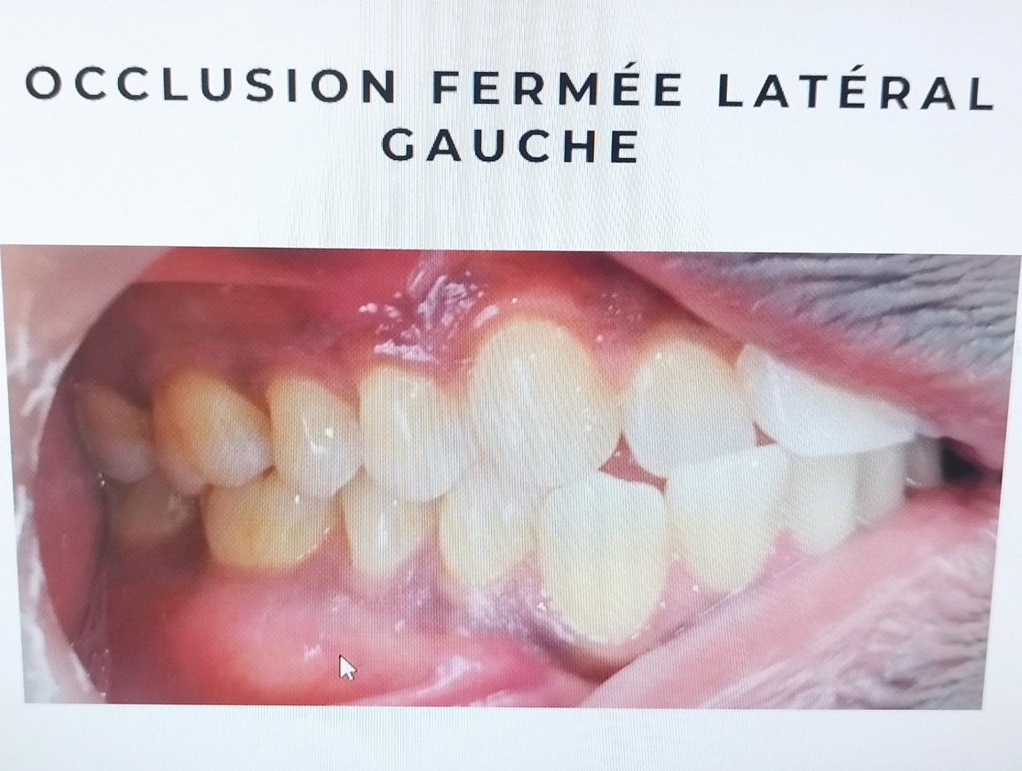 blanchiment dentaire à Tournan en Brie