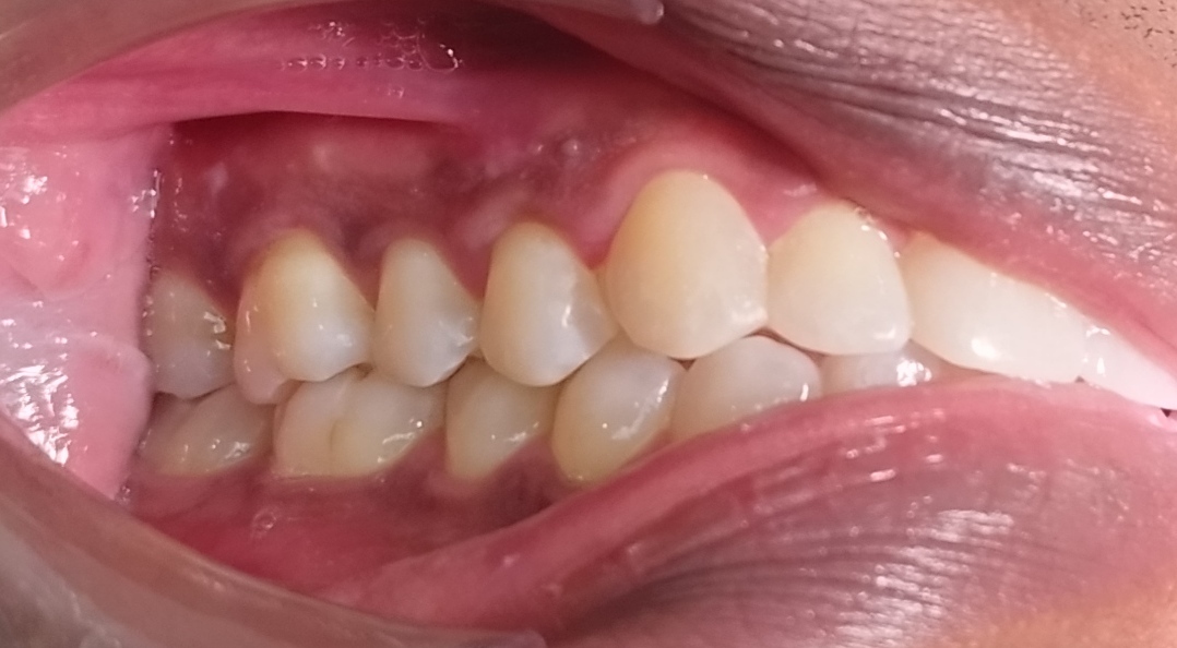 blanchiment dentaire apres Tournan en Brie