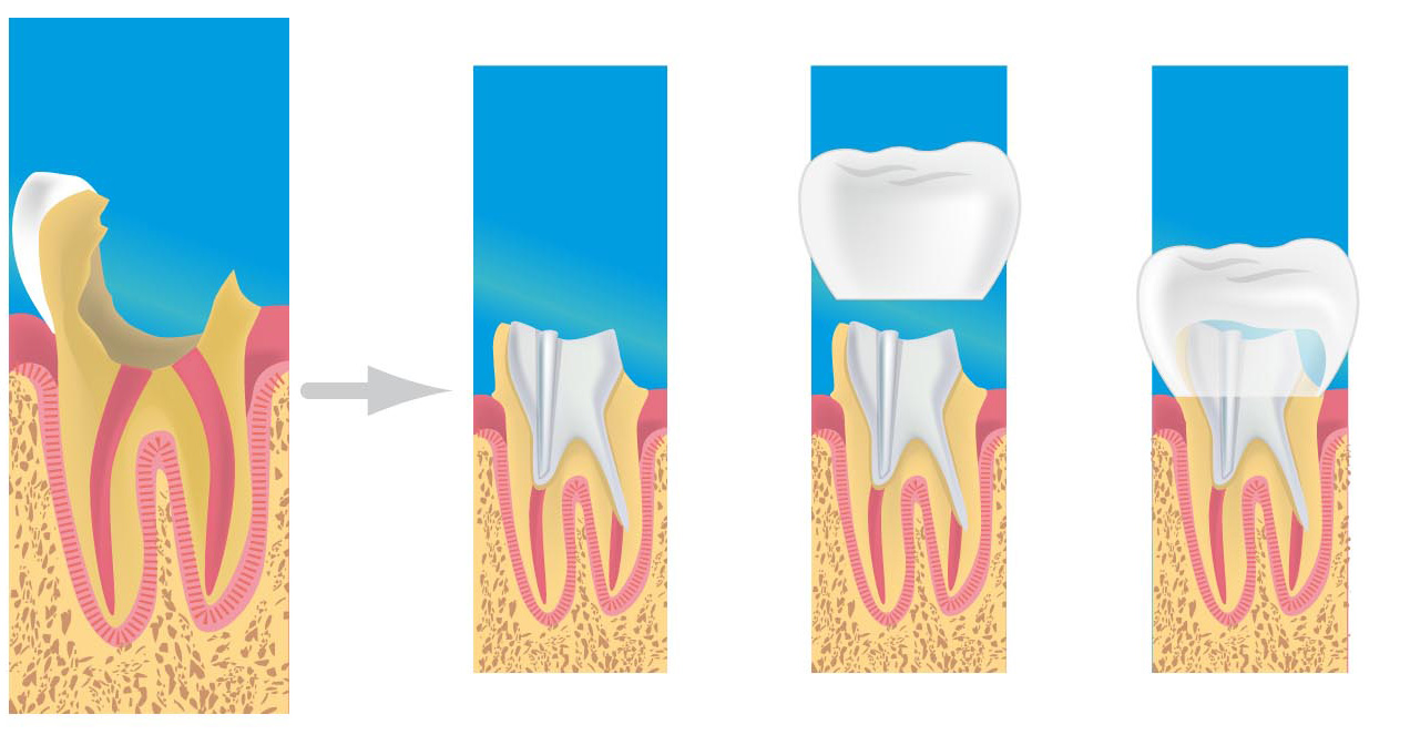 prothese dentaire gretz-armainvilliers