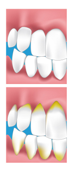 parodontie dentaire Tournan en Brie