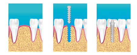 Implant dentaire Pontault-Combault